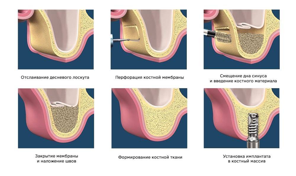 Синусы зуба. Односторонний закрытый синус-лифтинг. Открытый синус лифтинг схема. Операция закрытый синус-лифтинг. Открытый и закрытый синус лифтинг методика.